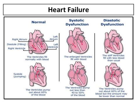 stages of left ventricular failure